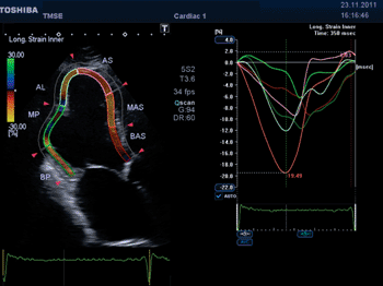 Image: Regional strain analysis in posterolateral infarction: Apical long axis view shows normal contraction of the anterior wall segments with the red and orange color. The posterior wall segments (green) show a typical low systolic longitudinal strain value of the inner myocardial layer with a delayed peak in early diastole in the posterolateral infarcted zone (Photo courtesy of Toshiba Medical).